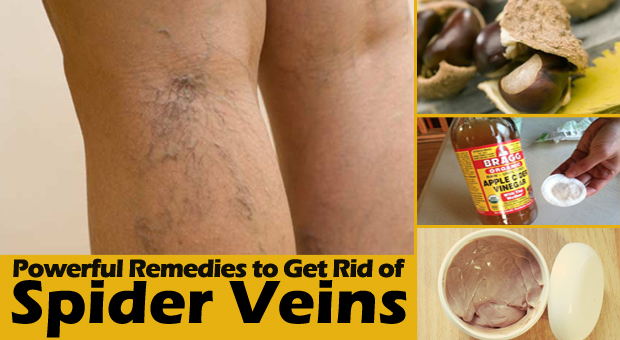 Get Rid of Spider Veins