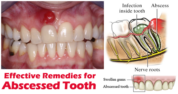 Home Remedies for Abscessed Tooth