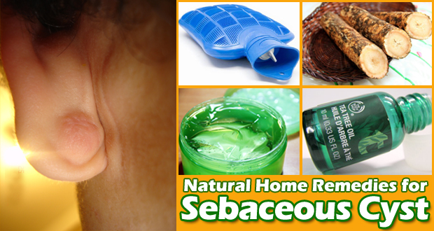 Remedies for Sebaceous Cyst