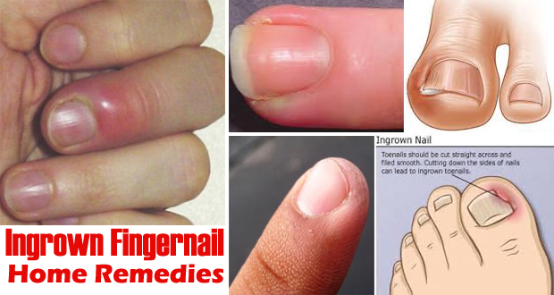 How to Get Rid of Ingrown Fingernails
