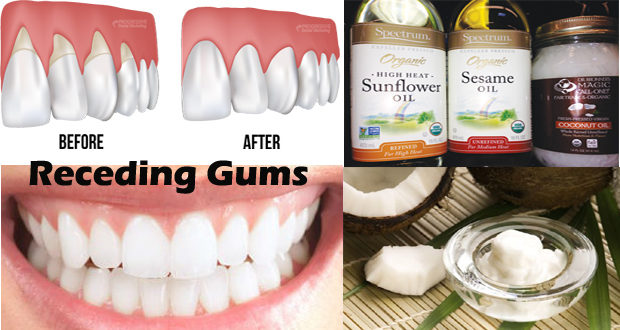 Remedies for Receding Gums