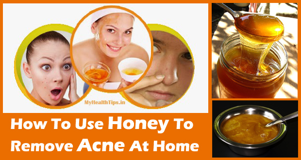 Honey for Acne – Use Honey to Remove Acne and its Scars