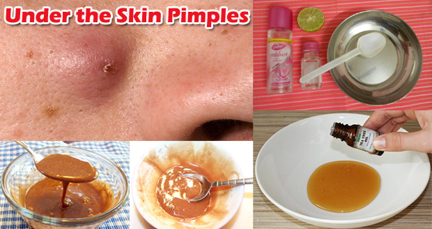 How To Get Rid Of Under The Skin Pimples