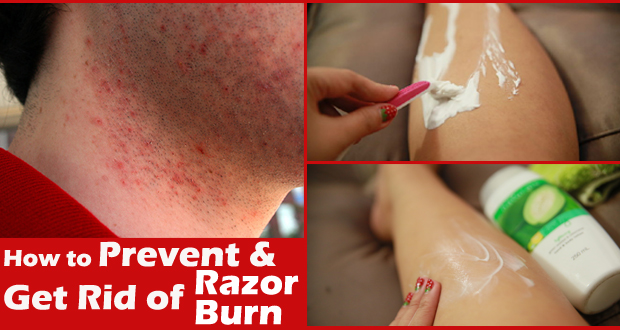 How to Get Rid of Razor Burn