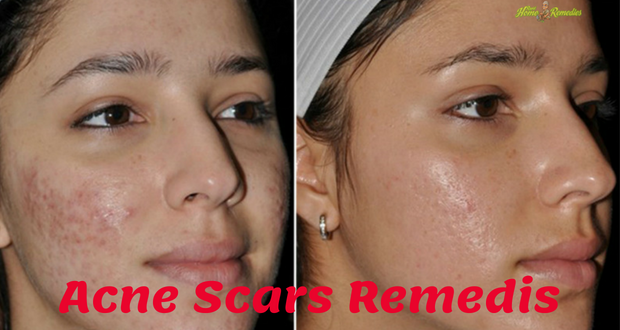 11 Top Home remedies to Remove Acne Scars Fast