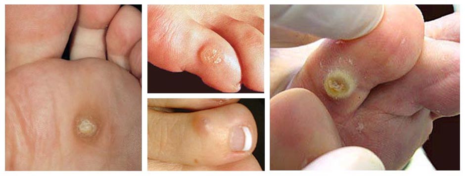 How to Get Rid of Corns on Toes