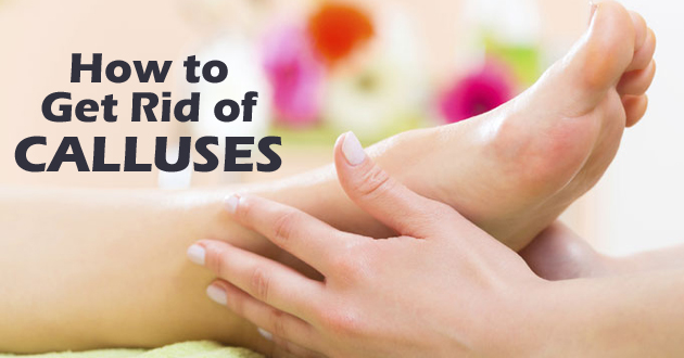 How to Get Rid of Calluses