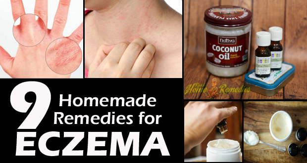 How to Get Rid of Eczema