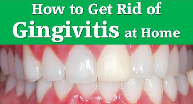 How to Get Rid of Gingivitis Fast at Home