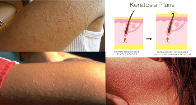 How to get rid of Keratosis Pilaris