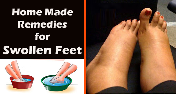 swollen feet remedies