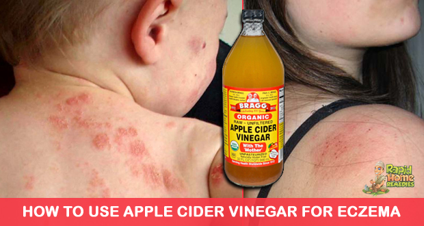 How to Use Apple Cider Vinegar for Eczema