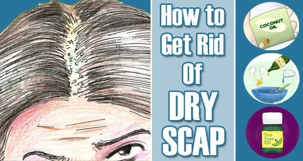 Get Rid of Dry Scalp