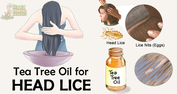 Tea Tree Oil to Remove Head Lice