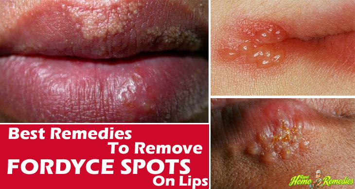 Remedies for Fordyce Spots