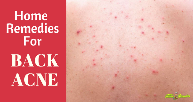 Get Rid of Back Acne with Top 15 Home Remedies
