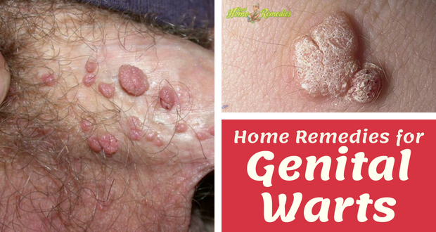 How to Get Rid of Genital Warts: Top 18 Home Remedies